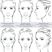 Neuramis Volume Lidocaine - Нейрамис Волюм с лидокаином